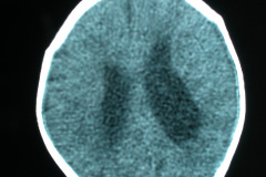 hipoplasia-cuerpo-calloso-colpocefalia-calcificacion-gangliobasal-2006-023