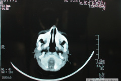 hipoplasia-cuerpo-calloso-colpocefalia-calcificacion-gangliobasal-2006-024