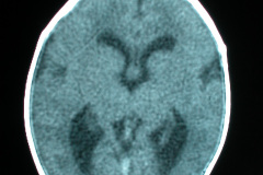 hipoplasia-cuerpo-calloso-colpocefalia-calcificacion-gangliobasal-2006-025