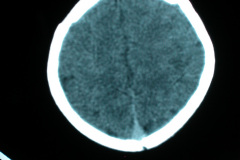 hipoplasia-cuerpo-calloso-colpocefalia-calcificacion-gangliobasal-2006-027