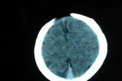 hipoplasia-cuerpo-calloso-colpocefalia-calcificacion-gangliobasal-2006-029