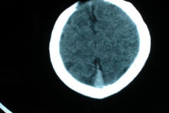 hipoplasia-cuerpo-calloso-colpocefalia-calcificacion-gangliobasal-2006-030
