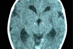 hipoplasia-cuerpo-calloso-colpocefalia-calcificacion-gangliobasal-lamina-cuadrigeica-tac-2006-001