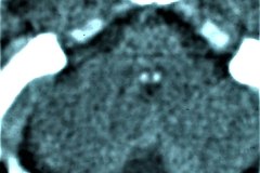 hipoplasia-cuerpo-calloso-colpocefalia-calcificacion-gangliobasal-lamina-cuadrigeica-tac-2006-003