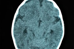 hipoplasia-cuerpo-calloso-colpocefalia-calcificacion-gangliobasal-lamina-cuadrigeica-tac-2006-004