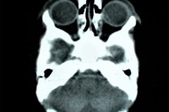 hipoplasia-cuerpo-calloso-colpocefalia-calcificacion-gangliobasal-lamina-cuadrigeica-tac-2006-005