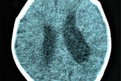 hipoplasia-cuerpo-calloso-colpocefalia-calcificacion-gangliobasal-lamina-cuadrigeica-tac-2006-007
