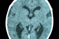 hipoplasia-cuerpo-calloso-colpocefalia-calcificacion-gangliobasal-lamina-cuadrigeica-tac-2006-008