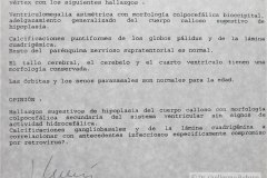 hipoplasia-cuerpo-calloso-colpocefalia-calcificacion-gangliobasal-lamina-cuadrigeica-tac-2006-012