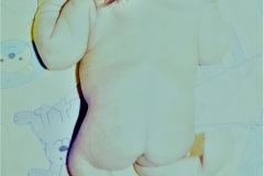 hipoplasia-femur-luxacion-de-rodillas-000