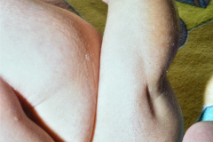 hipoplasia-femur-luxacion-de-rodillas-002