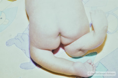 hipoplasia-femur-luxacion-de-rodillas-005