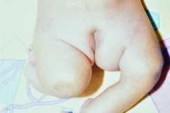 hipoplasia-femur-luxacion-de-rodillas-006