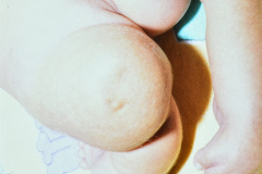hipoplasia-femur-luxacion-de-rodillas-009