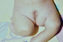 hipoplasia-femur-luxacion-de-rodillas-010