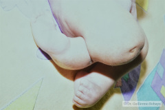 hipoplasia-femur-luxacion-de-rodillas-012