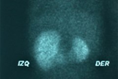hipoplasia-renal-der-gamagrafia-2005-000