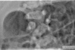 hipoplasia-vertebral-izq-hemivertebra-lumbar-der-2009-000
