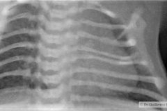 hipoplasia-vertebral-izq-hemivertebra-lumbar-der-2009-001