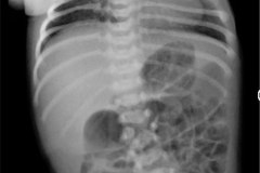 hipoplasia-vertebral-izq-hemivertebra-lumbar-der-2009-002