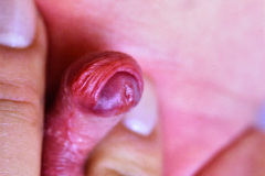 hipospadias-anterior-balanica-glande-002