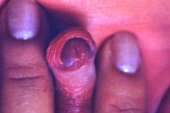 hipospadias-anterior-balanica-glande-004