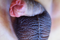 Hipospadias anterior (balanica) glanular – Dr. Guillermo Robayo