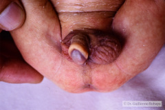 hipospadias-posterior-escrotal-006