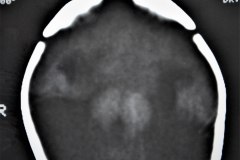 holoprosencefalia-alobar-2d10d-1991-000