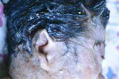 holoprosencefalia-alobar-ciclopia-000