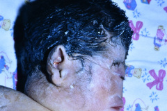 holoprosencefalia-alobar-ciclopia-007