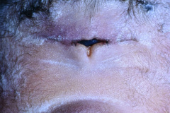 holoprosencefalia-alobar-ciclopia-008