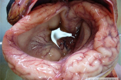 holoprosencefalia-alobar-patologia-2005-004