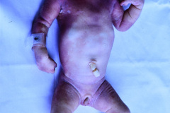 holoprosencefalia-alobar-proboscide-ciclopia-arrinia-anotia-criptorquidia-013