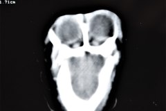 holoprosencefalia-rnm-1998-001