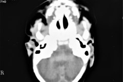 holoprosencefalia-rnm-1998-016