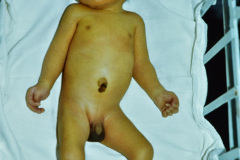 holoprosencefalia-semilobar-hipotelorismo-microftalmia-izq-labio-paladar-hendidos-central-linea-unica-palmar-000