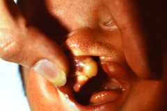 holoprosencefalia-semilobar-hipotelorismo-microftalmia-izq-labio-paladar-hendidos-central-linea-unica-palmar-002