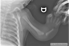holt-oram-agenesia-radio-hipoplasia-cubito-fractura-costal-patologica-izq-2m-2009-000