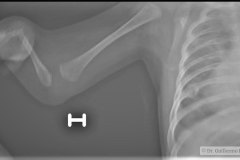 holt-oram-agenesia-radio-hipoplasia-cubito-fractura-costal-patologica-izq-2m-2009-001