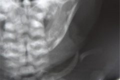 huesos-wornianos-fractura-clavicula-serendipia-cefalohematoma-1990-000