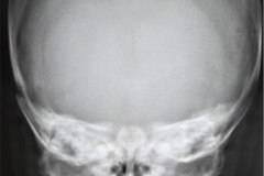 huesos-wornianos-fractura-clavicula-serendipia-cefalohematoma-1990-004