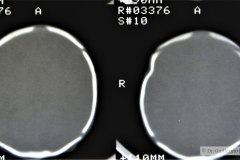 hundimiento-parietal-der-tac-1992-006