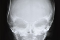 hundimiento-parietal-der-tac-1992-009
