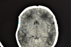 hundimiento-parietal-der-tac-1992-011