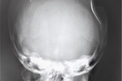 hundimiento-parietal-izq-hematoma-subdural-tac-1993-000