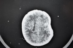 hundimiento-parietal-izq-hematoma-subdural-tac-1993-008