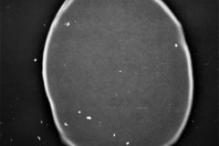 hundimiento-parietal-izq-hematoma-subdural-tac-1993-009