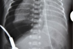 iatogenia-neumotorax-tubo-endotraqueal-sobreinsertado-colapso-pulmonar-2003-000