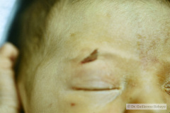 iatrogenia-lasceracion-ceja-der-trauma-espatula-1992-000